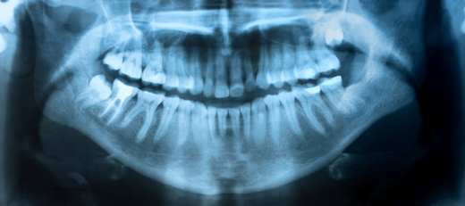 Dental X-Ray