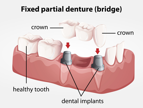 denture