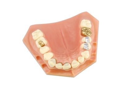 Dental model (with different treatments)