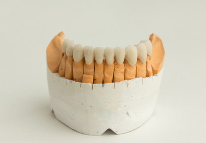 porcelain veneers