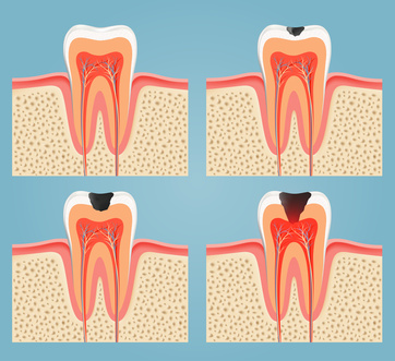 root  canal